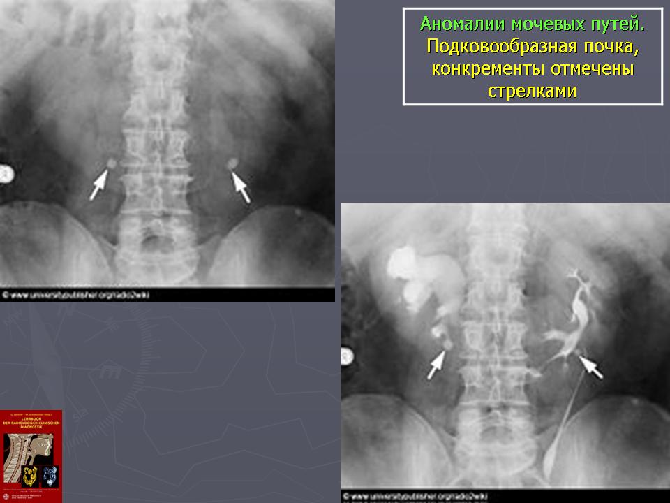 Горбатая почка. Подковообразная почка урография. Подковообразная почка рентген. Аномалии развития почек рентген. Подковообразная почка на УЗИ.