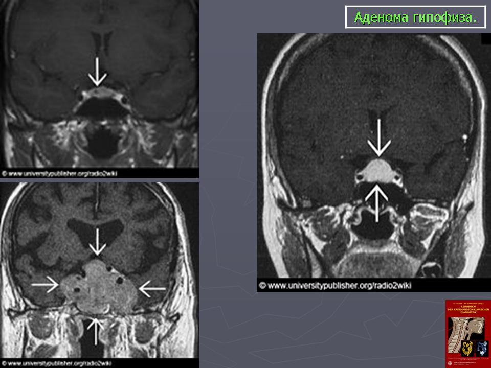 Мр картина микроаденомы гипофиза что это