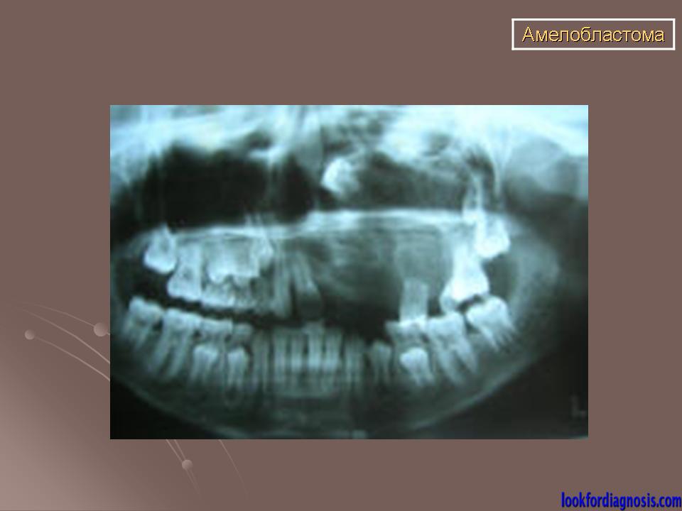 Клиническая картина амелобластомы