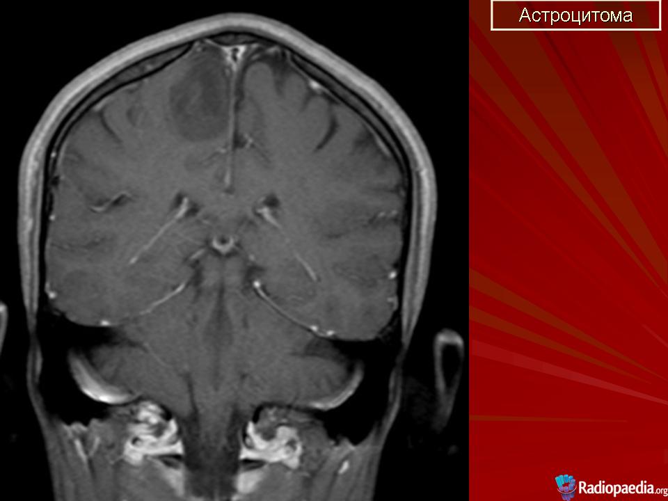 Диффузная астроцитома. Диффузная астроцитома кт. Анапластическая астроцитома кт. Диффузная астроцитома g2.