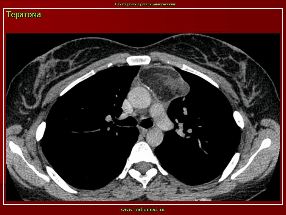 Рак средостения фото