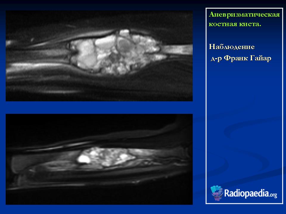 Киста костного мозга. Аневризматическая киста бедренной кости на кт. Аневризмальная костная киста бедренной кости мрт. Аневризмальная костная киста бедренной кости кт.