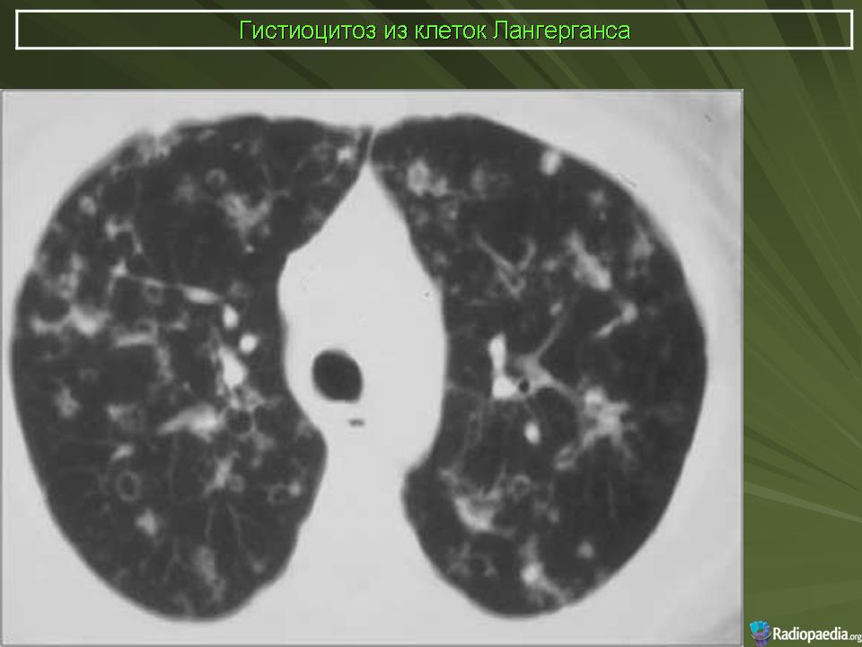 Гистиоцитоз х рентгенологическая картина