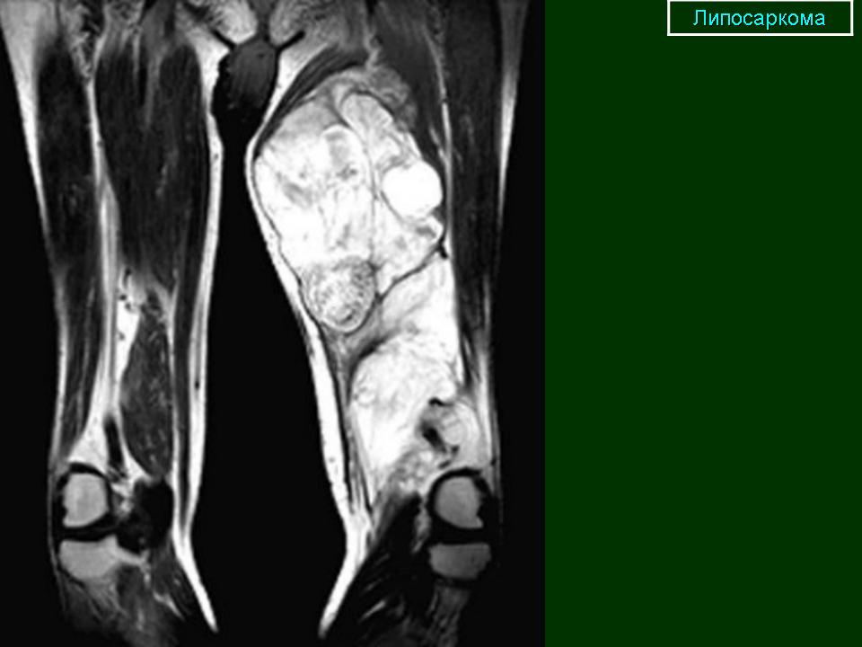 Саркома кт. Липосаркома коленного сустава. Саркома мягких тканей бедра мрт.
