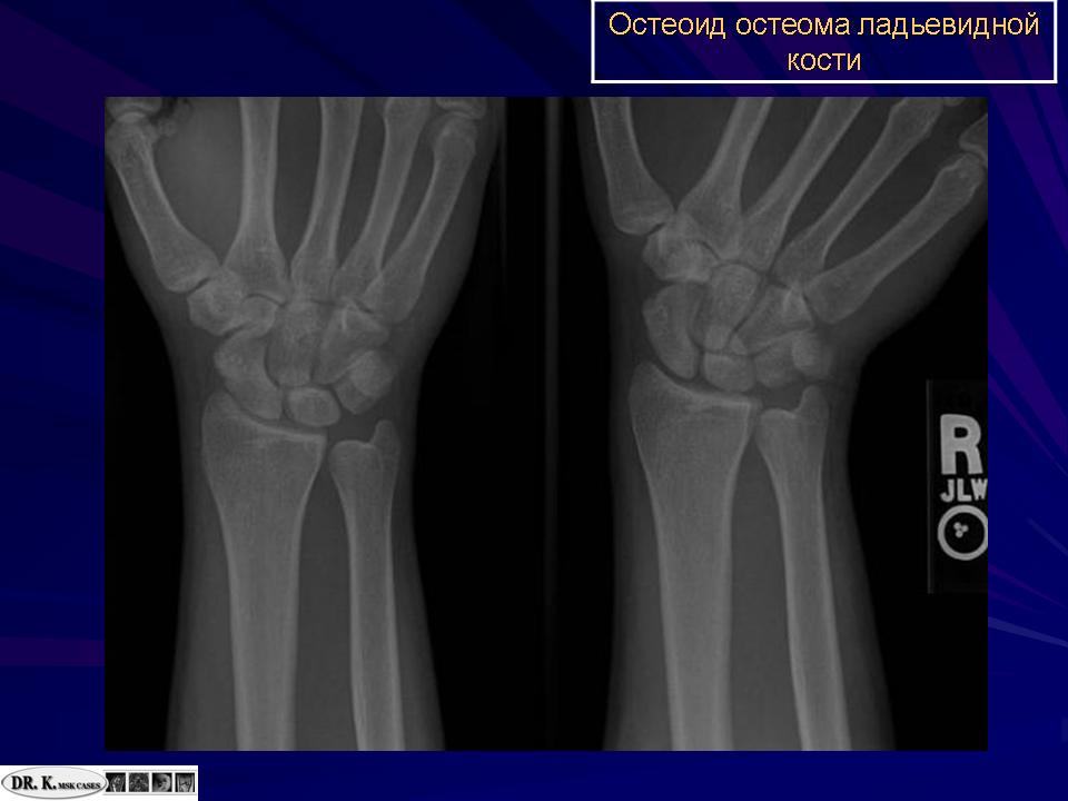 Остеома это. Остеома лучевой кости на кт. Остеома лучевой кости руки. Остеома ладьевидной кости.