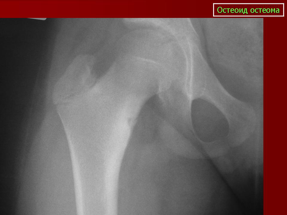 Остеоид остеома бедренной кости