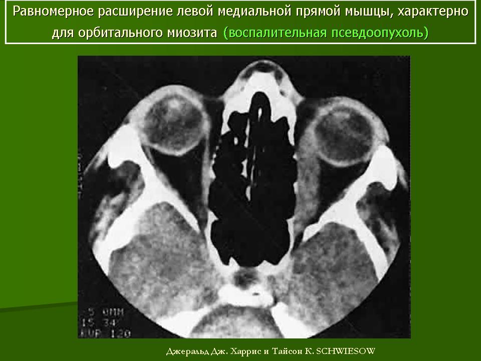 Расширение левой. Орбитальный абсцесс на кт.