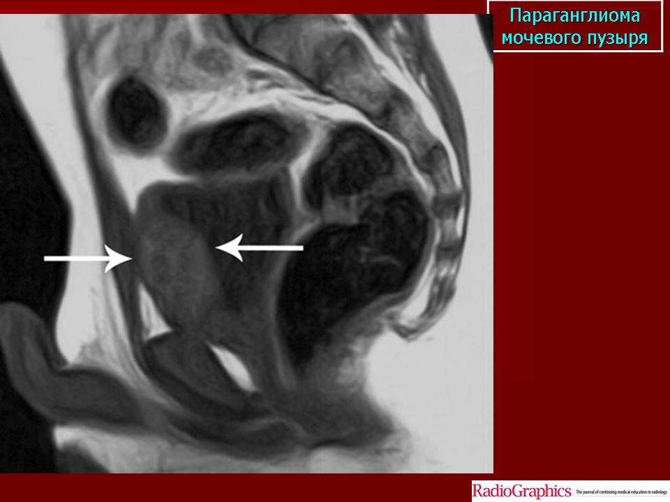 Параганглиома что это. Параганглиома мочевого пузыря. Параганглиома мочевого пузыря кт. Параганглиома мочевого пузыря мрт.