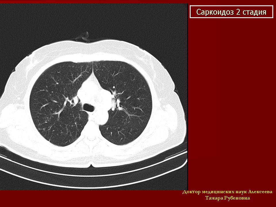 Кт картина саркоидоза легких