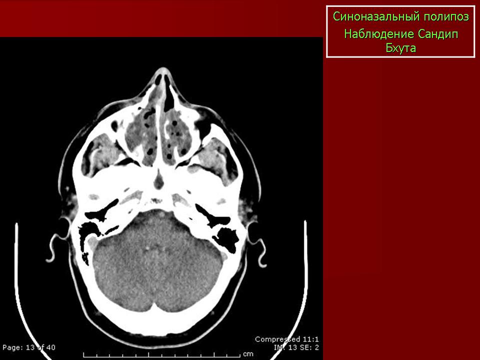 Мукоцеле синуса. Мукоцеле носового синуса кт. Мукоцеле лобной пазухи на кт. Мукоцеле верхнечелюстной пазухи кт.