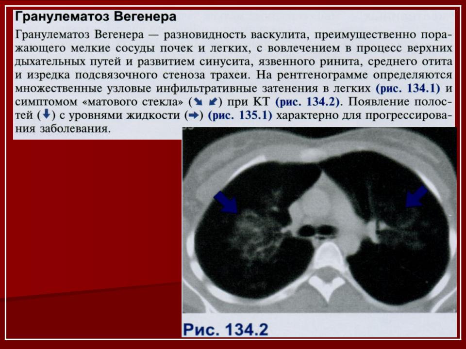 Гранулематоз. Синдром Вегенера кт легких. Гранулематоз Вегенера кт легких. Гранулематоз Вегенера на кт лёгких. Вегенера болезнь кт картина.