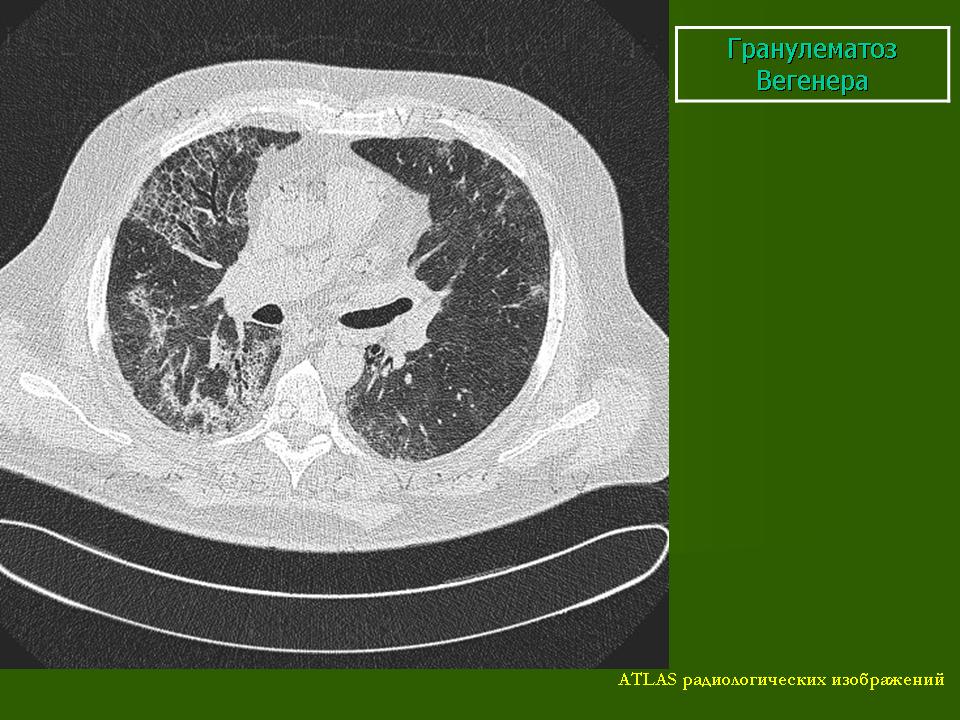 Гранулематоз. Вегенера болезнь кт картина. Гранулематоз Вегенера кт. Кт картина гранулематоза Вегенера.