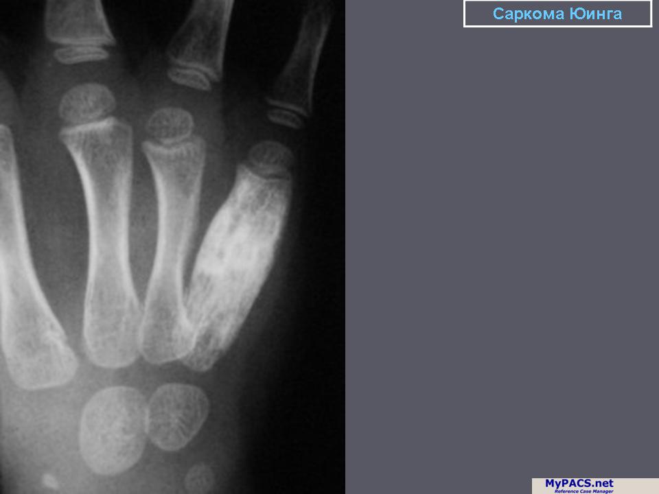 Саркома юинга у детей. Опухоль Юинга рентгенологическая картина. Саркомы костей рентген. Остеосаркомсаркома Юинга.