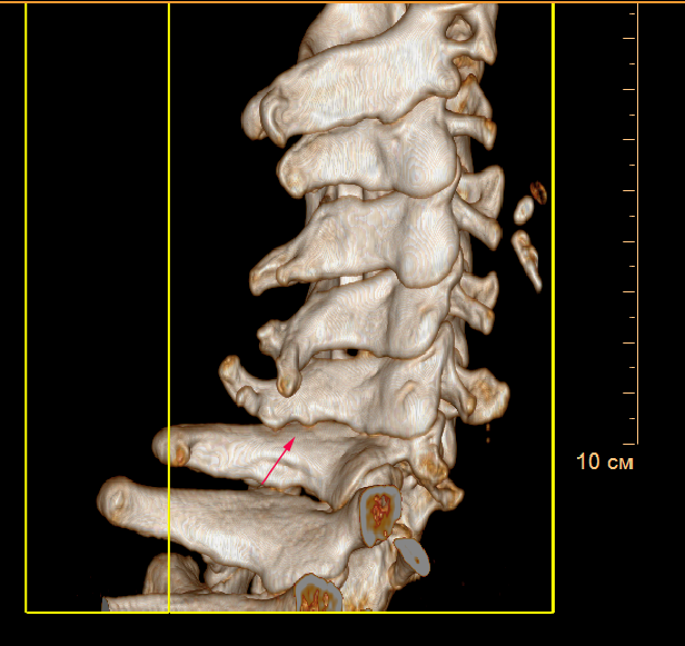 Остистый отросток 7 шейного позвонка фото