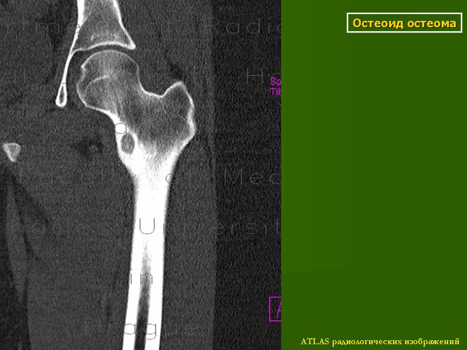 Остеома бедренной кости. Остеома большеберцовой кости на кт.