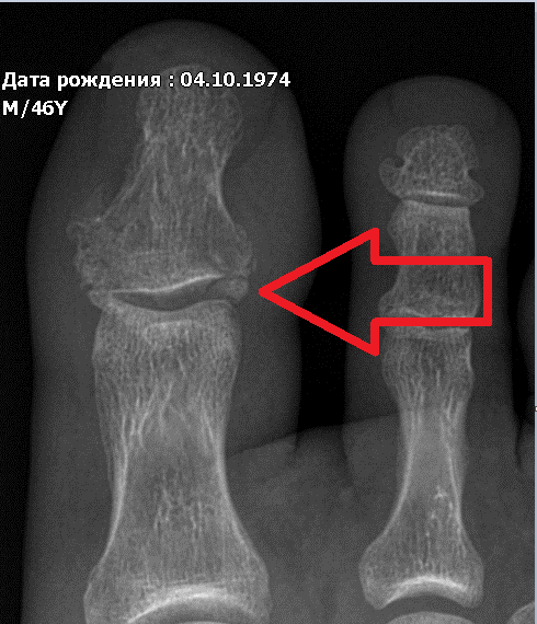 Вальгусная деформация первых пальцев стоп