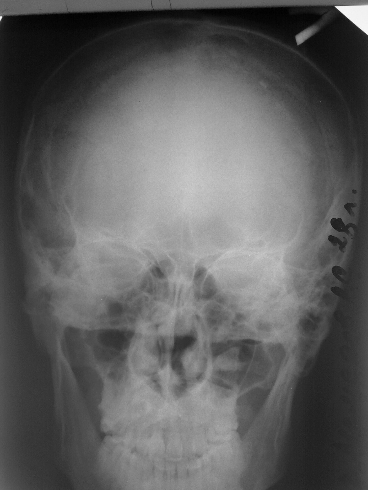 Гиперостоз лобной кости фото