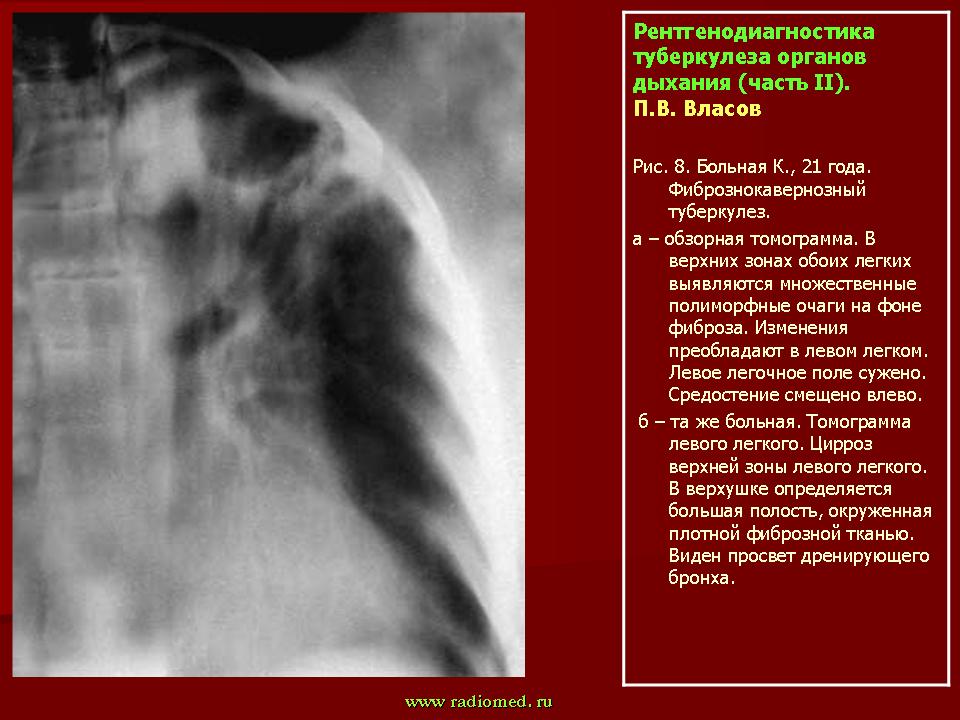 Туберкулез сегодня. Лучевая диагностика туберкулеза. Рентгенодиагностика туберкулеза. Туберкулез легких лучевая диагностика фтизиатрия.