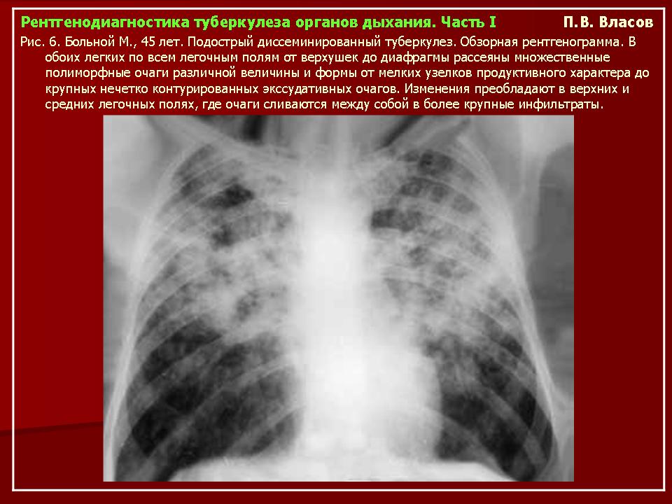 Лимфогенный туберкулез. Диссеминированный туберкулез на кт. Подострый диссеминированный туберкулез рентген. Хронический диссеминированный туберкулез рентген. Острый диссеминированный туберкулез рентген.