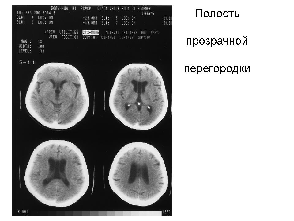 Полость прозрачной перегородки. Агенезия прозрачной перегородки мрт. Полость прозрачной перегородки головного мозга норма. Расширенная полость прозрачной перегородки. Прозрачная перегородка голова.