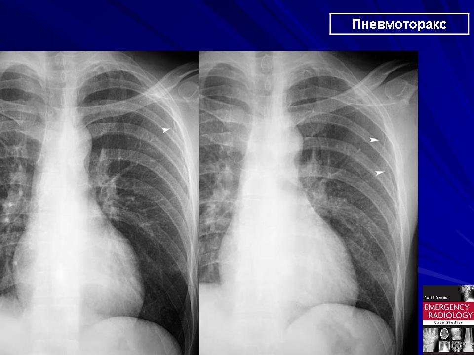 Рентген картина пневмоторакса