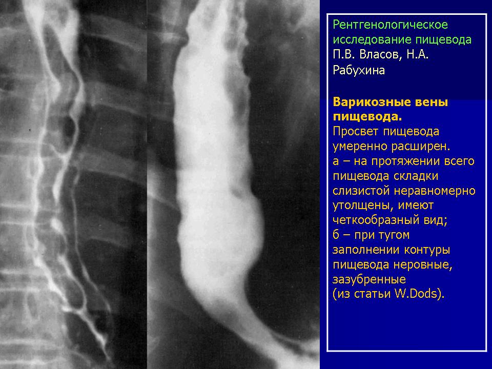 Сосуды пищевода. Варикоз вен пищевода рентген. Варикозное расширение вен пищевода рентгенограмма. Варикозное расширение вен пищевода рентген. Расширение вен пищевода рентгенограмма.