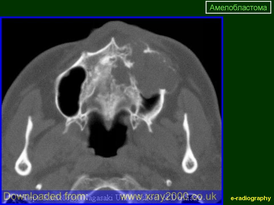 Клиническая картина амелобластомы