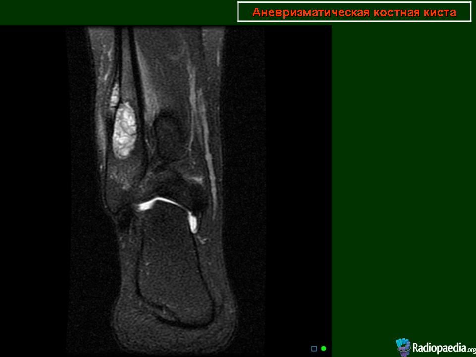 Мрт голеностопного сустава. Гигрома коленного сустава мрт. Синовиома голеностопного сустава мрт. Гигрома голеностопного сустава на мрт. Ганглиевая киста коленного сустава мрт.
