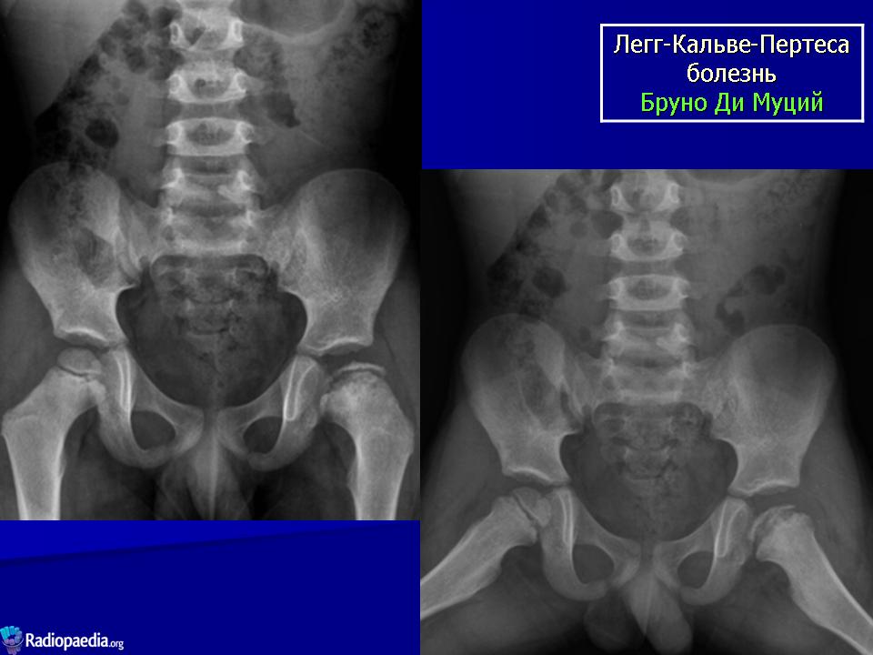 Болезнь пертеса презентация