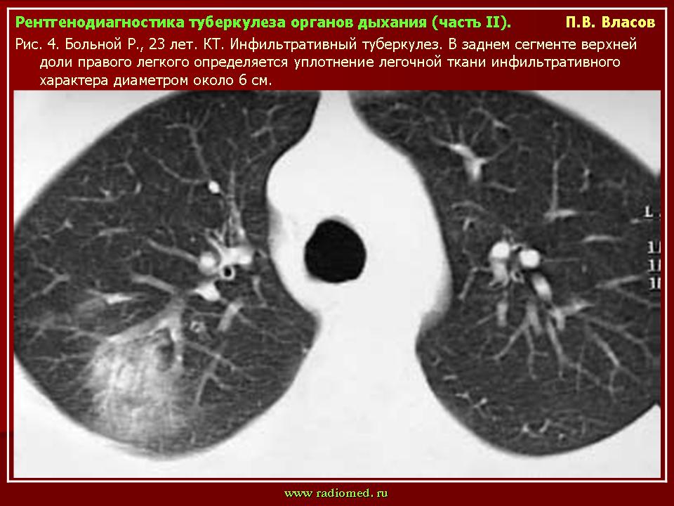 Фото кт легких при туберкулезе