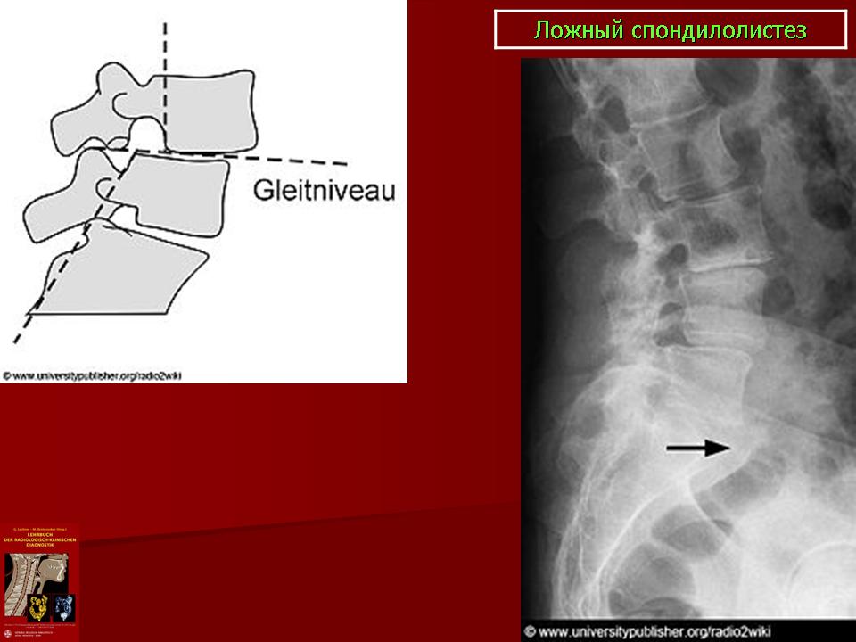 Спондилолистез. Истинный спондилолистез l5. Врожденный спондилолистез. Ложный спондилолистез. Истинный и ложный спондилолистез.