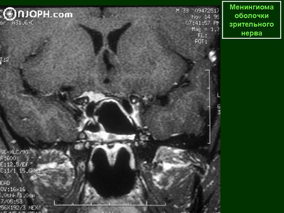 Объемное образования мозга мкб. Менингиома зрительного нерва мрт. Менингиома мкб. Менингиома около глазного нерва. Менингиома зрительного нерва клинические рекомендации.