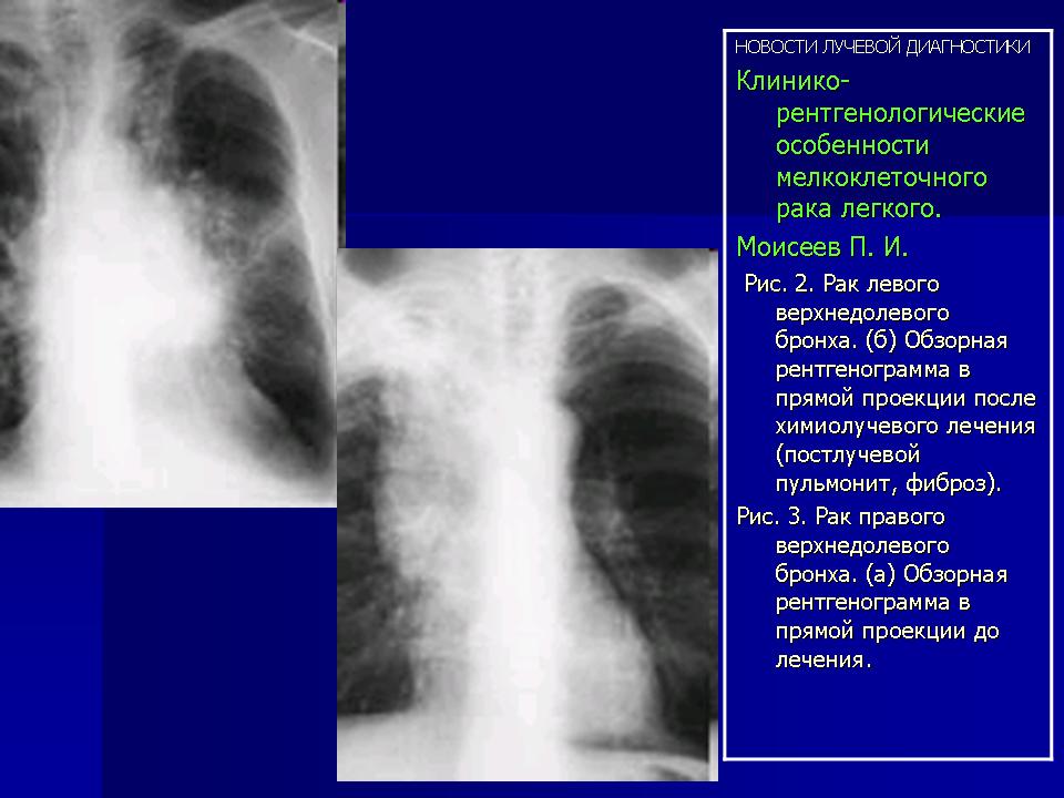Фиброз легких врач. Лимфома в легких на рентгенограмме. Рентгенодиагностика туберкуломы.