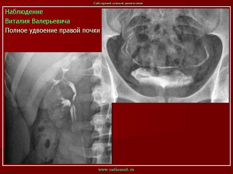 Применение уретероуретеростомии при удвоении почки | Экспериментальная и клиническая урология