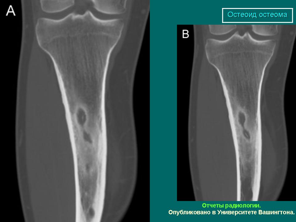 Остеоид остеома бедренной кости