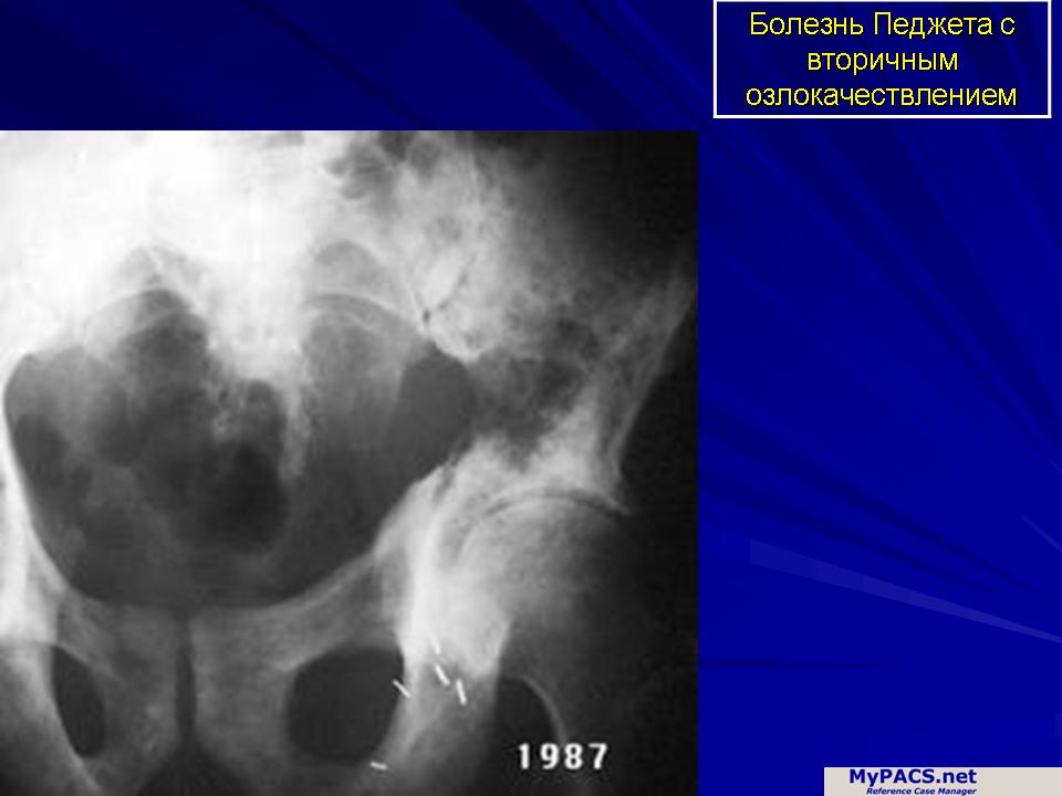 Болезнь педжета презентация
