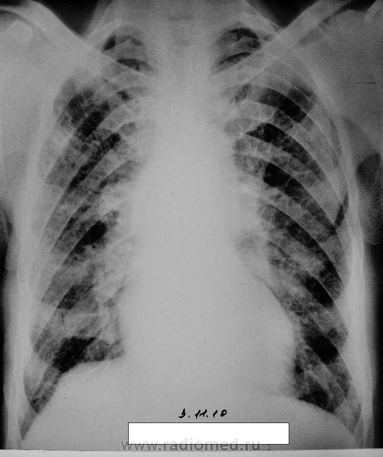 Диффузный пневмосклероз это рак. Пневмосклероз рентген. Диффузный пневмосклероз рентген. Диффузный пневмосклероз легких на рентгене. Пневмосклероз легких рентген.