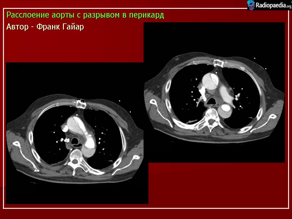 Расслоение аорты фото