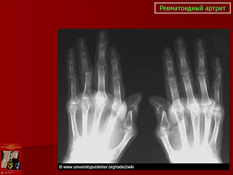 Рентген снимок кистей рук: зачем делать, что показывает, снимок здорового человека