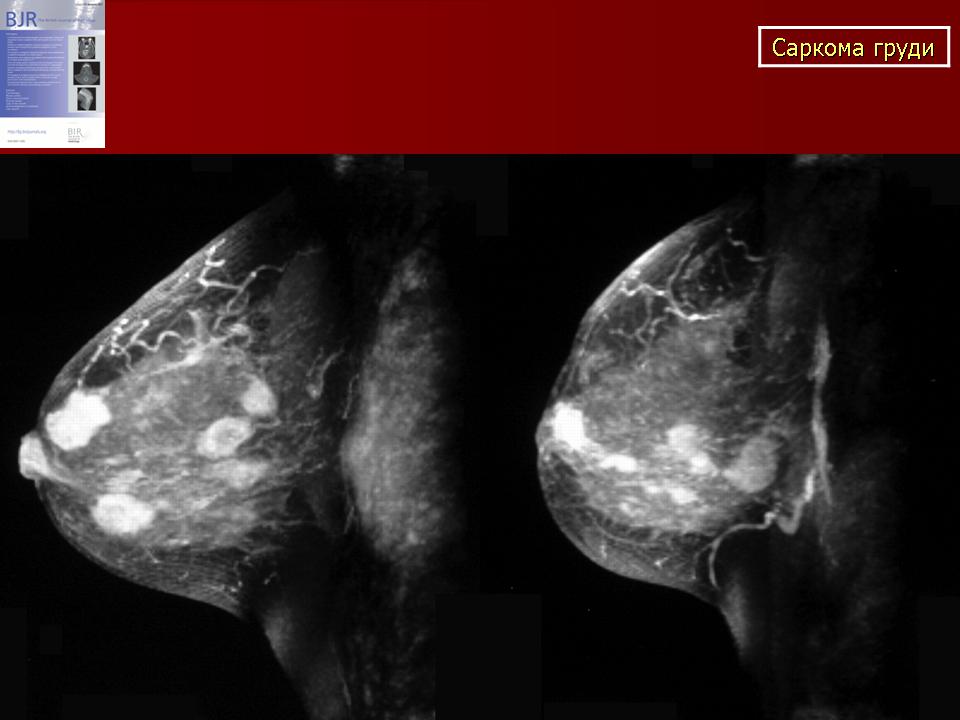 Как выглядит рак молочной железы на поверхности фото