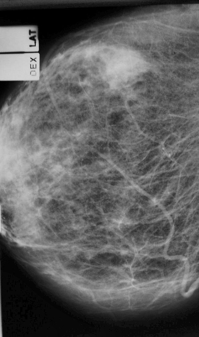 Маммография старый. Фибролипома маммография. Липома молочной железы на маммографии. Фибролипома молочной железы маммография. Плазмоцитарный мастит маммография.