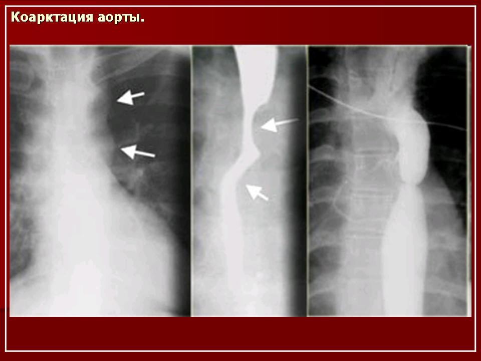 Коарктация аорты фото