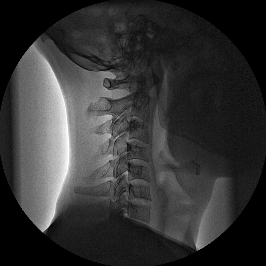 Как выглядит остеохондроз шейного отдела позвоночника фото