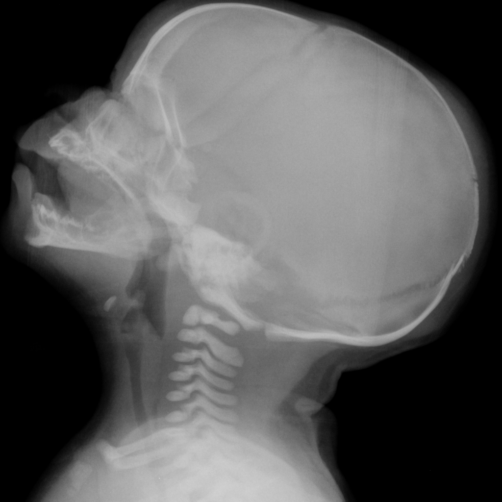 Трещина черепа у ребенка. Перелом затылочной кости рентген. Перелом теменной кости рентген. Оскольчатый перелом костей черепа. Перелом костей черепа рентген.