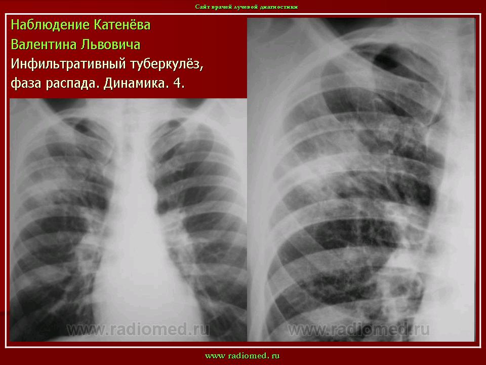 Инфильтративный распад легких. Бронхолобулярный инфильтративный туберкулез рентген. Инфильтративный туберкулез верхней доли рентген. Инфильтративный туберкулез s6. Инфильтративный туберкулез легкого рентген.