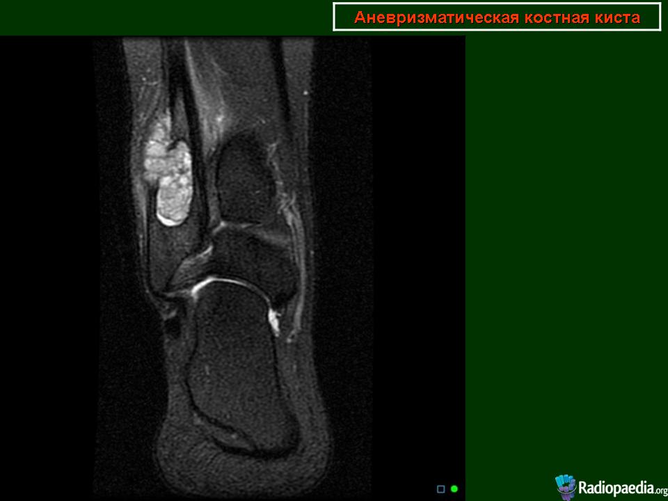Киста бейкера мрт. Аневризматическая киста бедренной кости на кт. Аневризматическая костная киста большеберцовой кости мрт. Аневризматическая киста плечевой кости мрт. Синовиальная киста коленного сустава мрт.