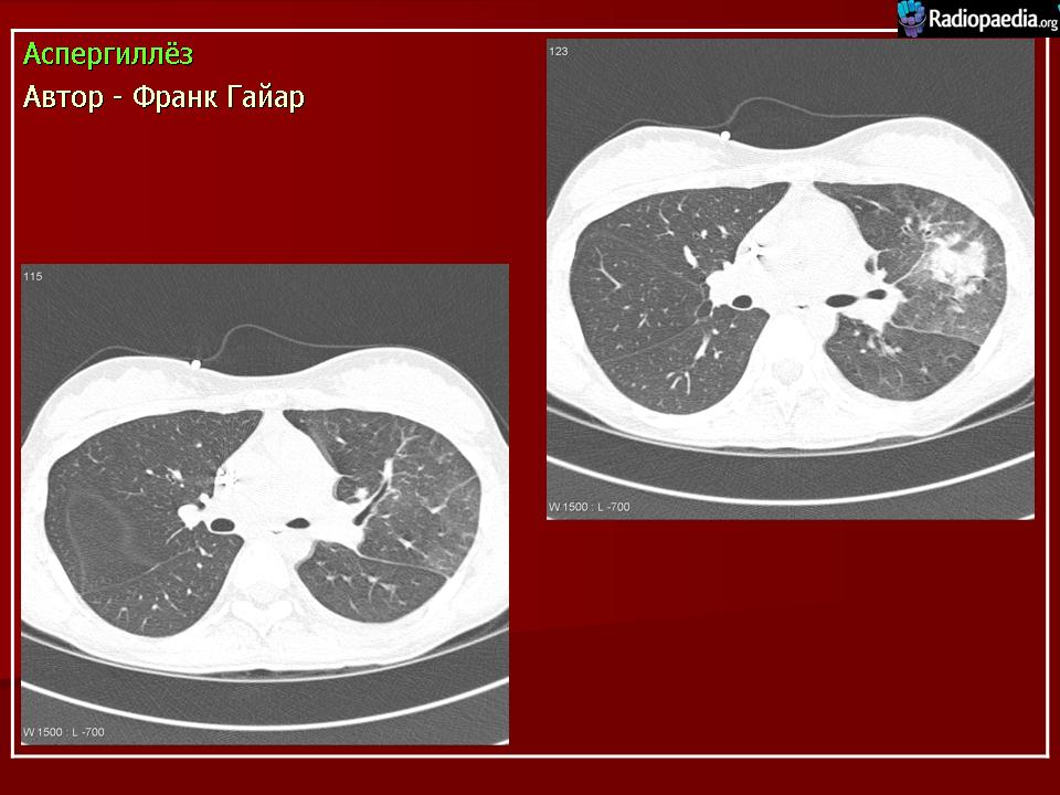 Аспергиллез кт картина