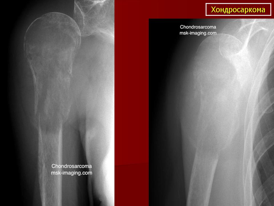 Хондросаркома. Хондросаркома бедренной кости кт. Хондросаркома плеча рентген. Хондросаркома рентген. Хондросаркома плеча кт.