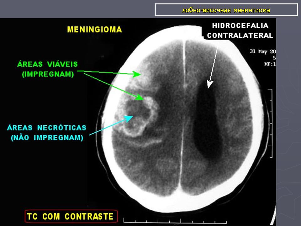 После операции менингиомы головного мозга. Менингиома головного мозга кт. Менинготелиальная менингиома. Менингиома кавернозного синуса. Менингиома височной доли мрт.