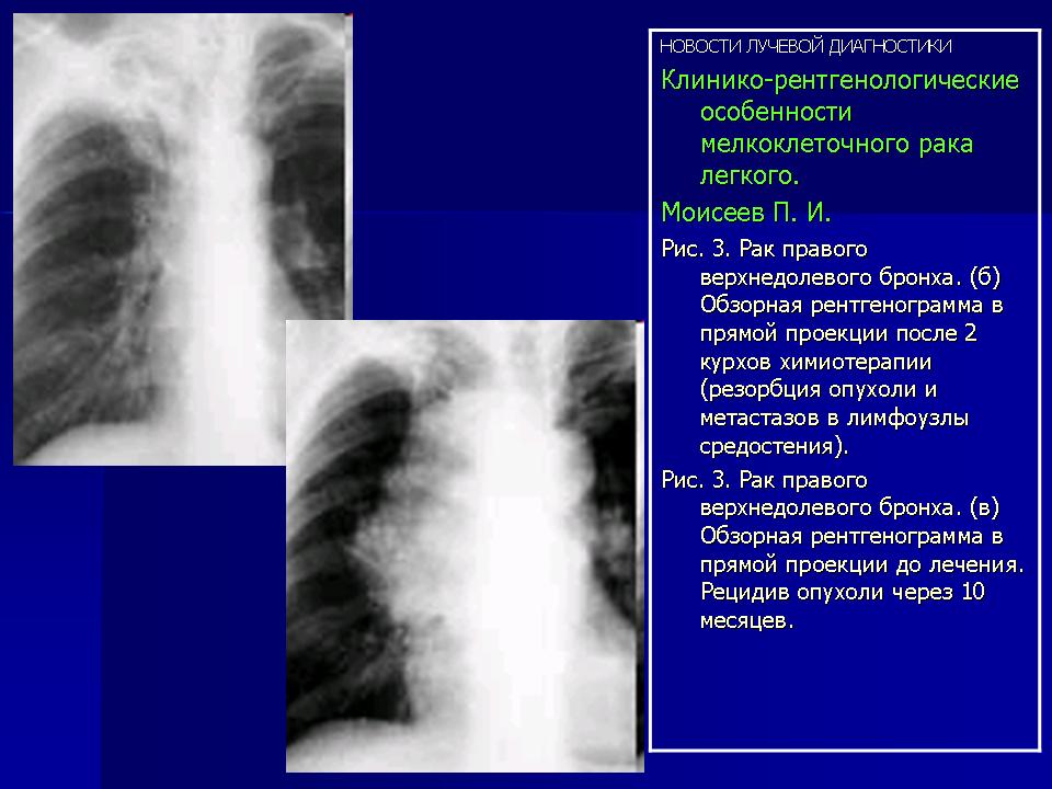 Лучевая картина центрального рака легкого